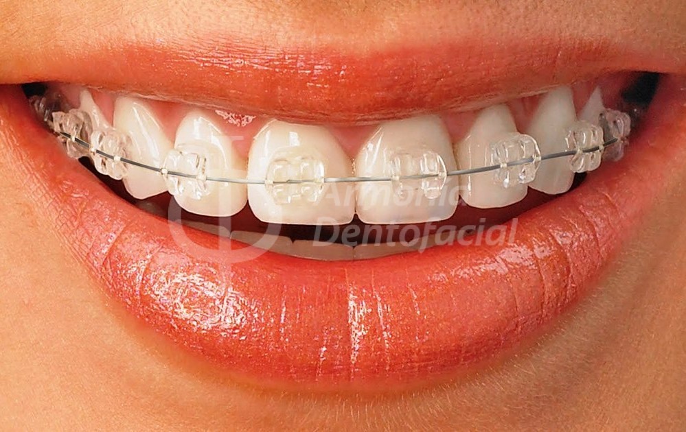 brackets, ortodoncia